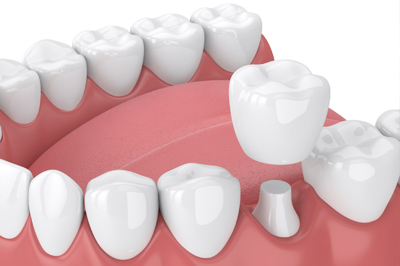 Dental Crowns in Georgetown