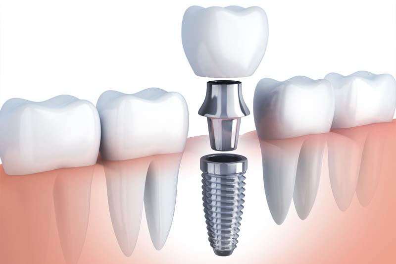 Implants Dentist in Georgetown
