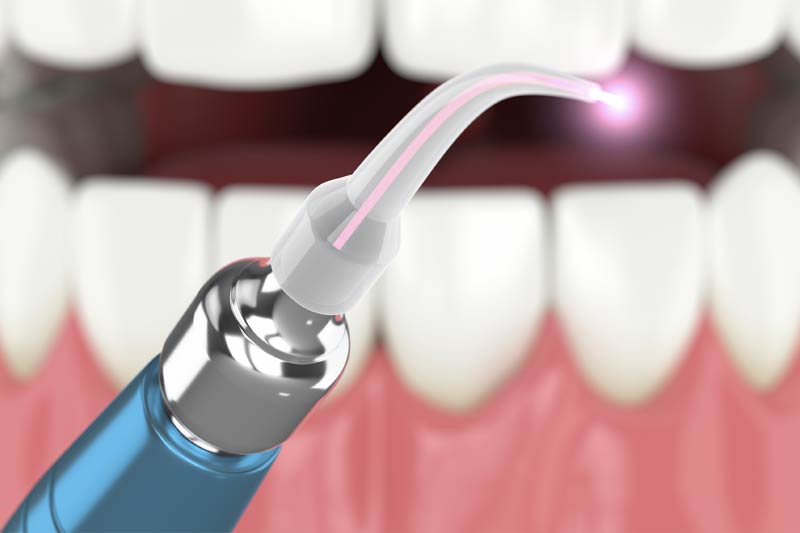 Laser Dentistry in Georgetown
