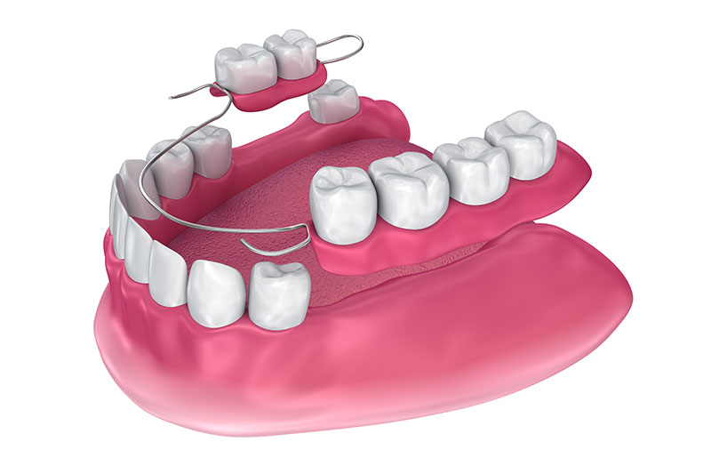 Partial Dentures in Georgetown