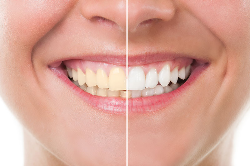 Teeth Whitening in Georgetown