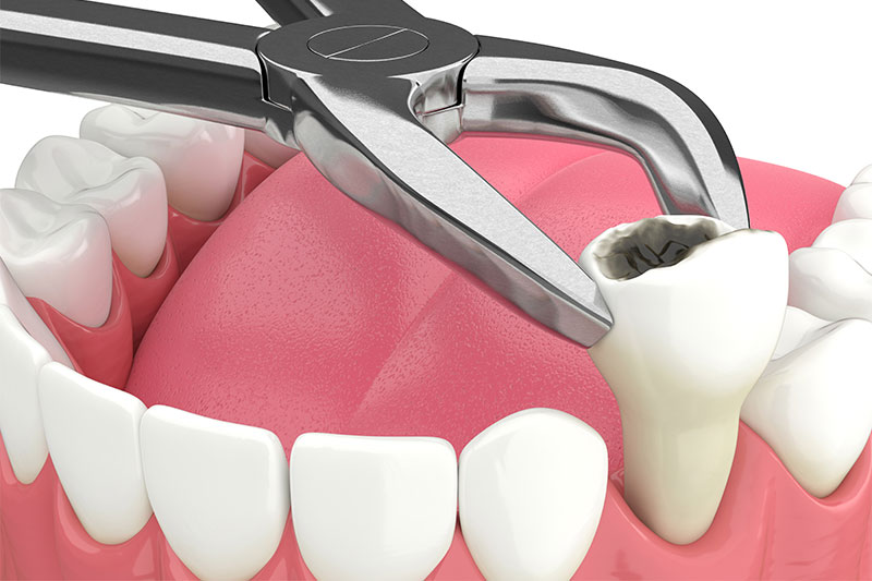 Tooth Extraction in Georgetown