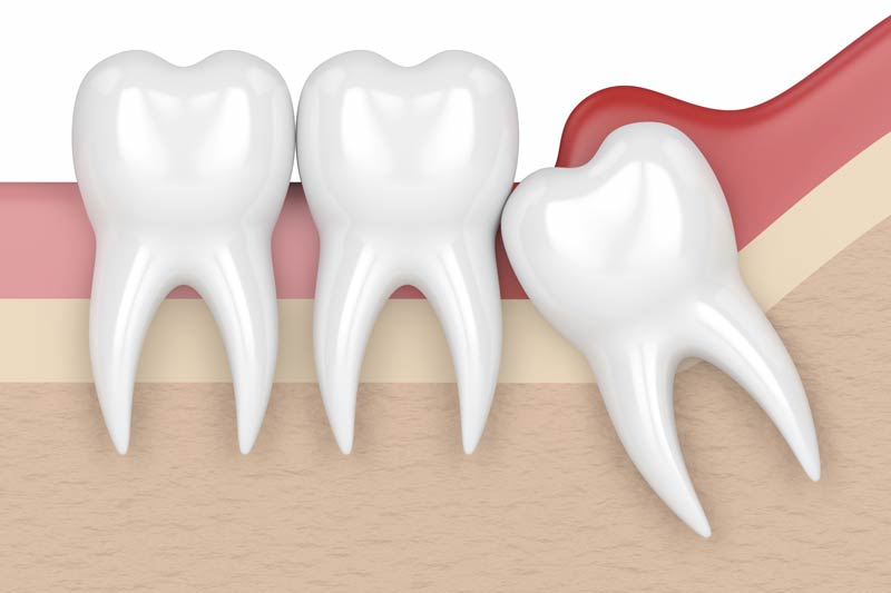 Wisdom Tooth Removal in Georgetown