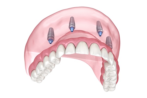 What Can I Expect After The All On  ® Procedure?