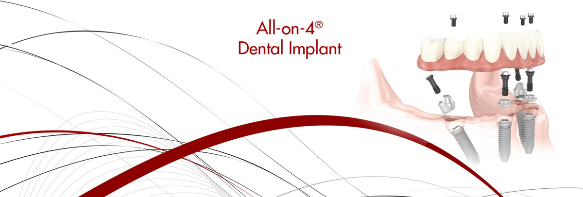 Georgetown All-on-4 Dental Implants