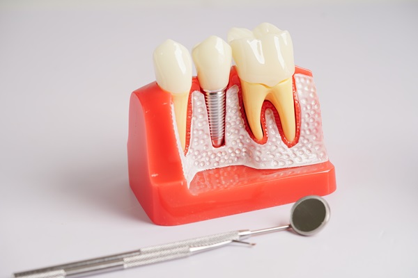 Can I Have Braces If I Have A Dental Implant?