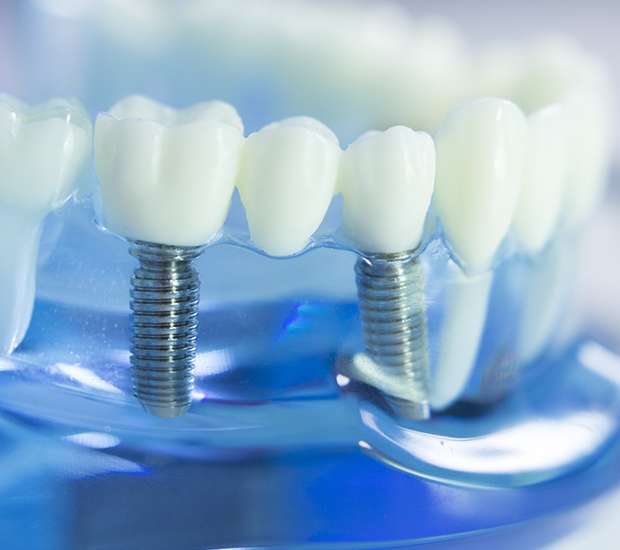 Georgetown Dental Implants