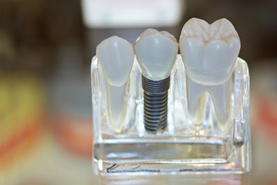 Factors To Consider When Qualifying For Dental Implants