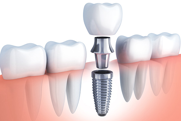 Questions to Ask Your Implant Dentist from Healthy Smiles Dentistry Georgetown in Georgetown, TX