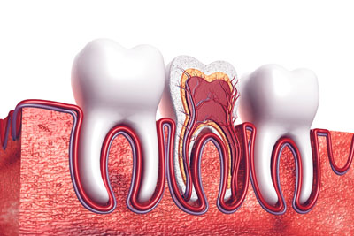 Get The Facts About Root Canal Therapy