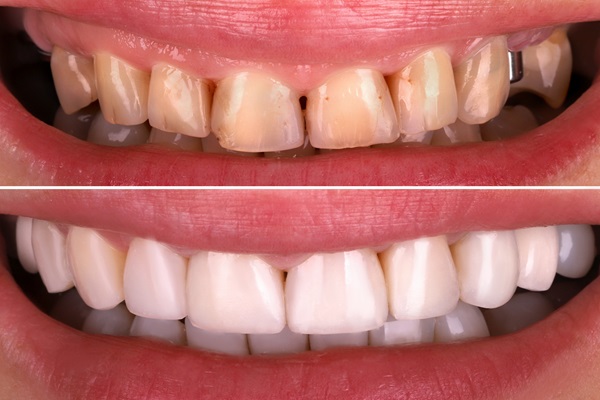 Smile Makeover Options For Damaged Teeth