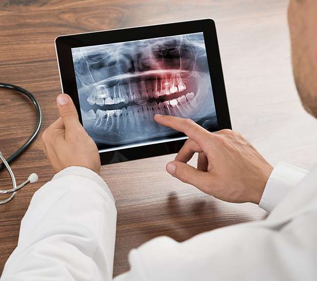 Georgetown Types of Dental Root Fractures