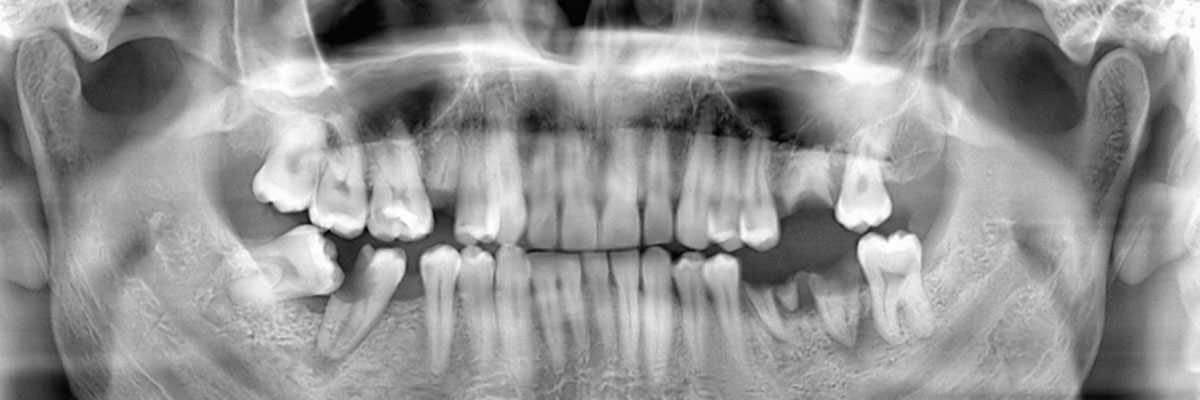 Georgetown Wisdom Teeth Extraction